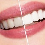 best teeth whitening method