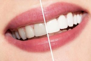 best teeth whitening method